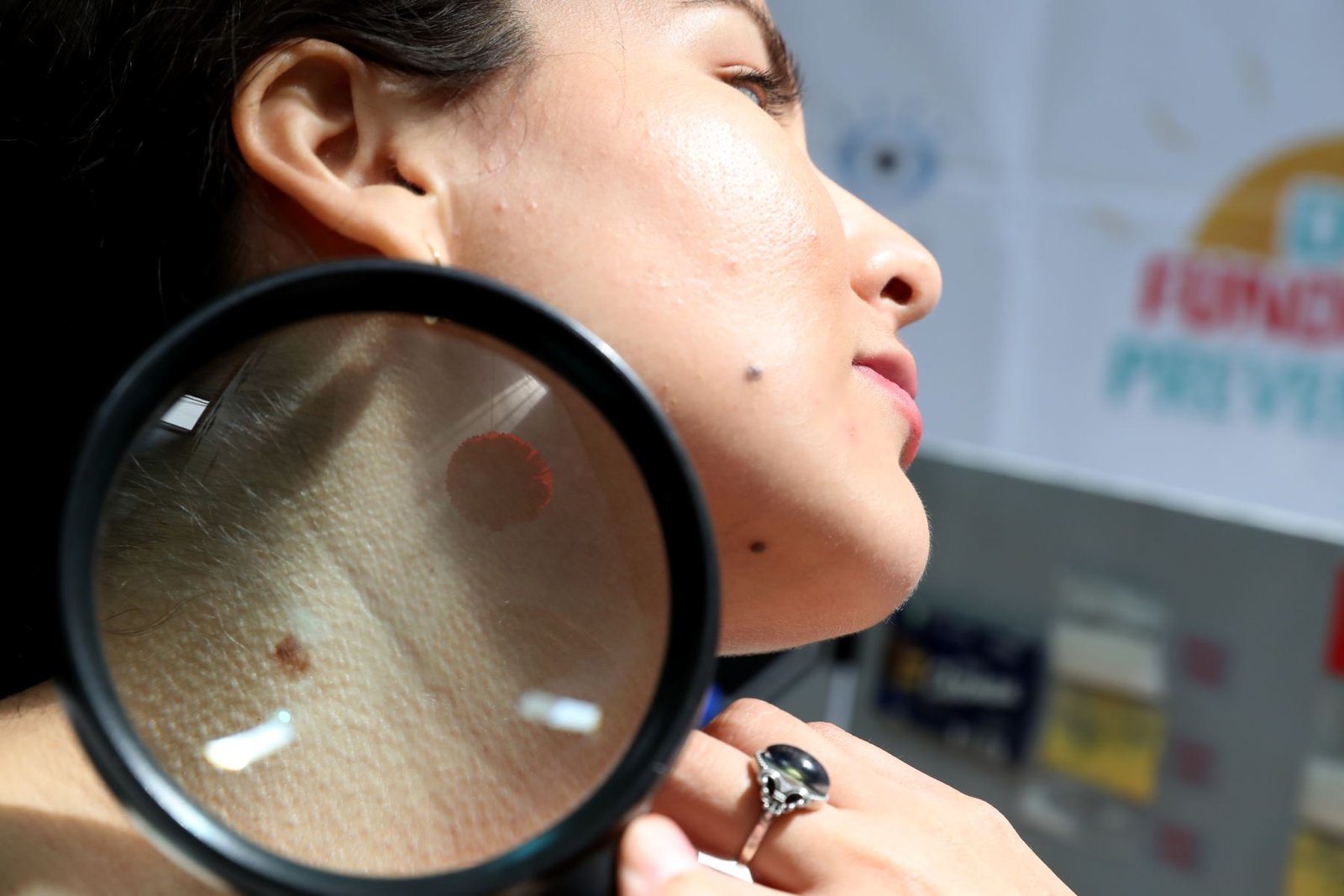 Día del lunar: manchas y lesiones sospechosas pueden ser síntomas de cáncer a la piel