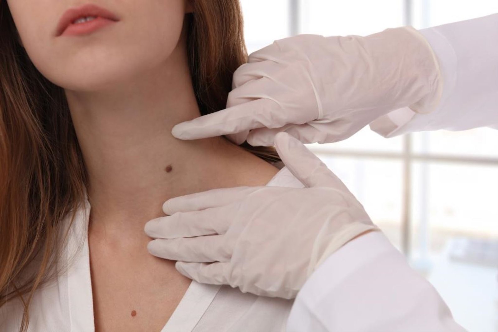 Lunares y riesgos: identifique señales de peligro de cáncer de piel