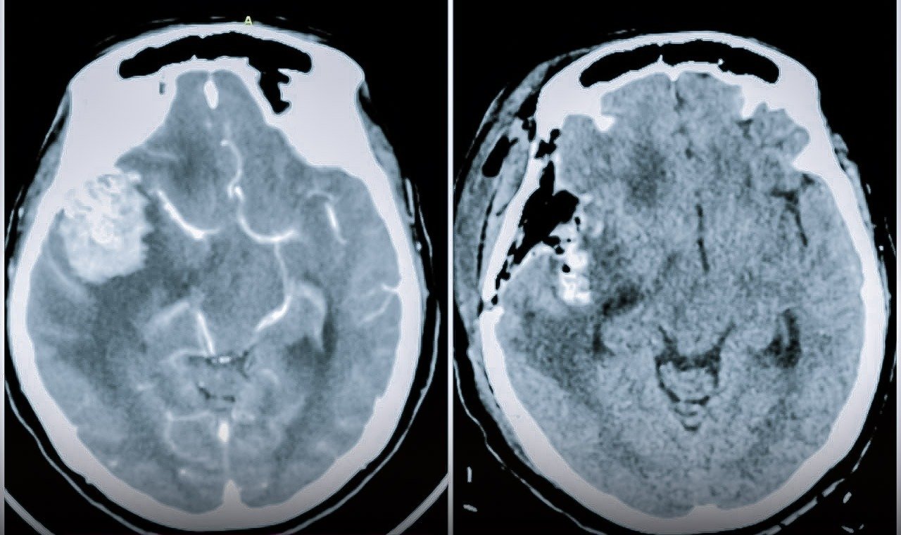 Médicos del Hospital Regional Hermilio Valdizán extirpan tumor cerebral a una paciente de 76 años